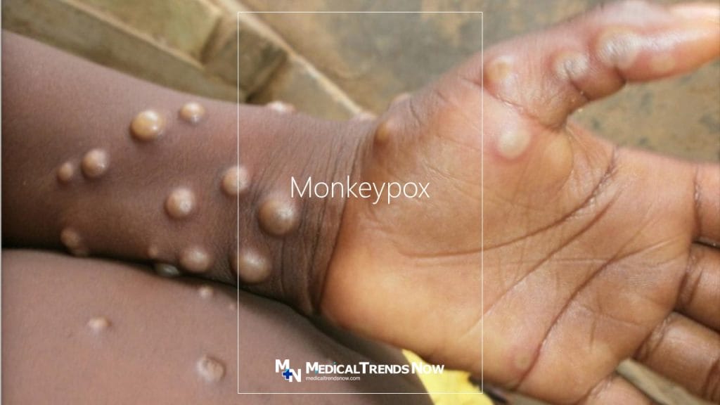 Monkeypox virus symptoms