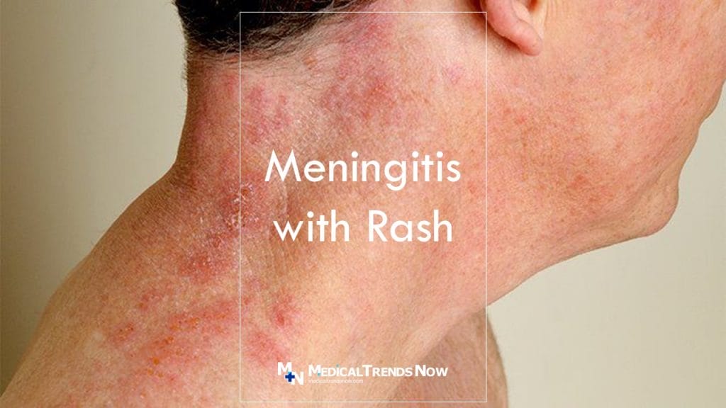 A man with Meningococcemia Meningitis with Rash