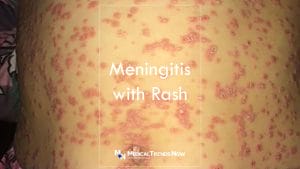 A boy with Meningococcemia Meningitis with Rash