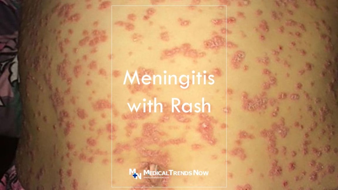 A boy with Meningococcemia Meningitis with Rash