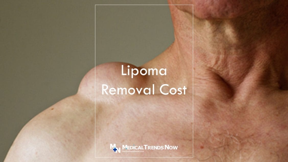 lipoma in the shoulder area