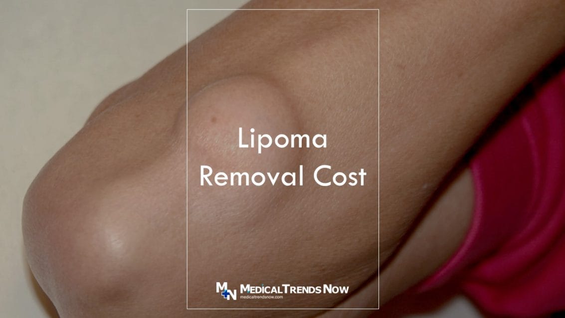 lipoma in the arm area