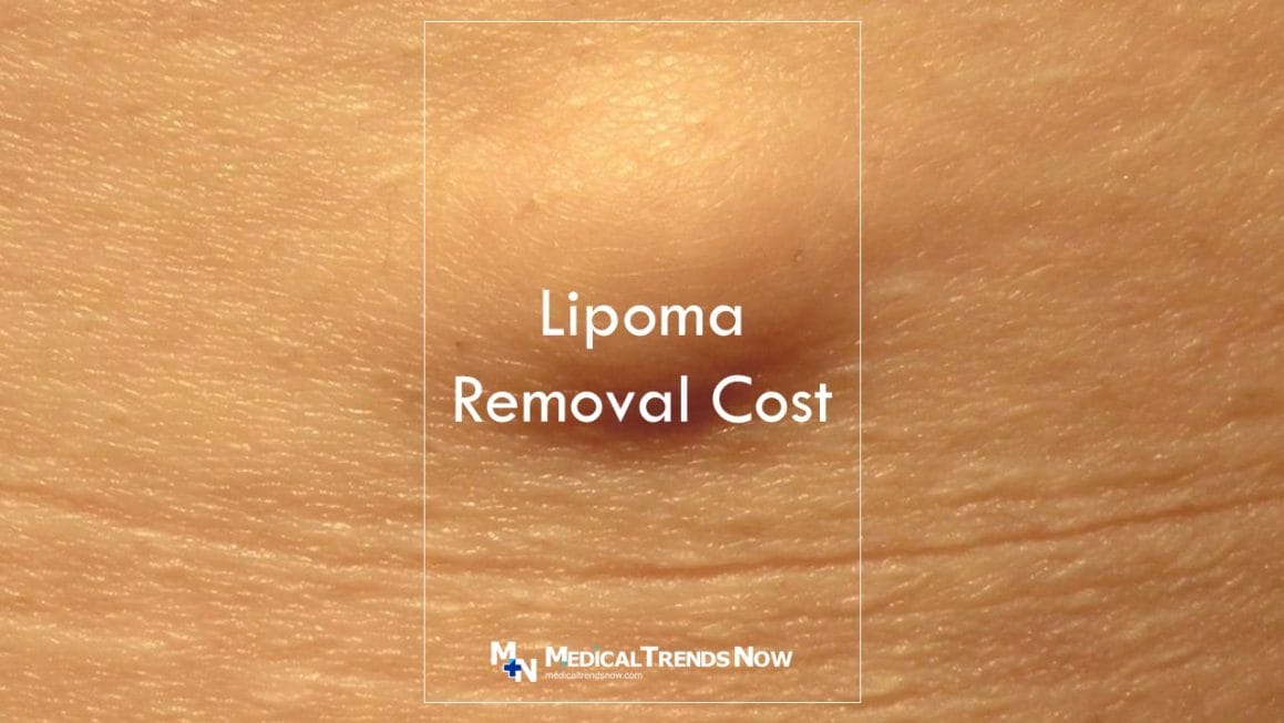 lipoma removal in the neck area