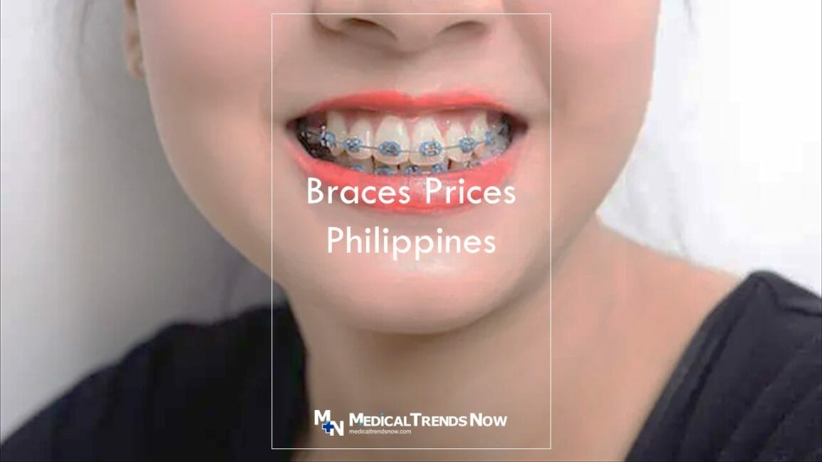 How Much are Braces in the Philippines? Ultimate Pricing Guide