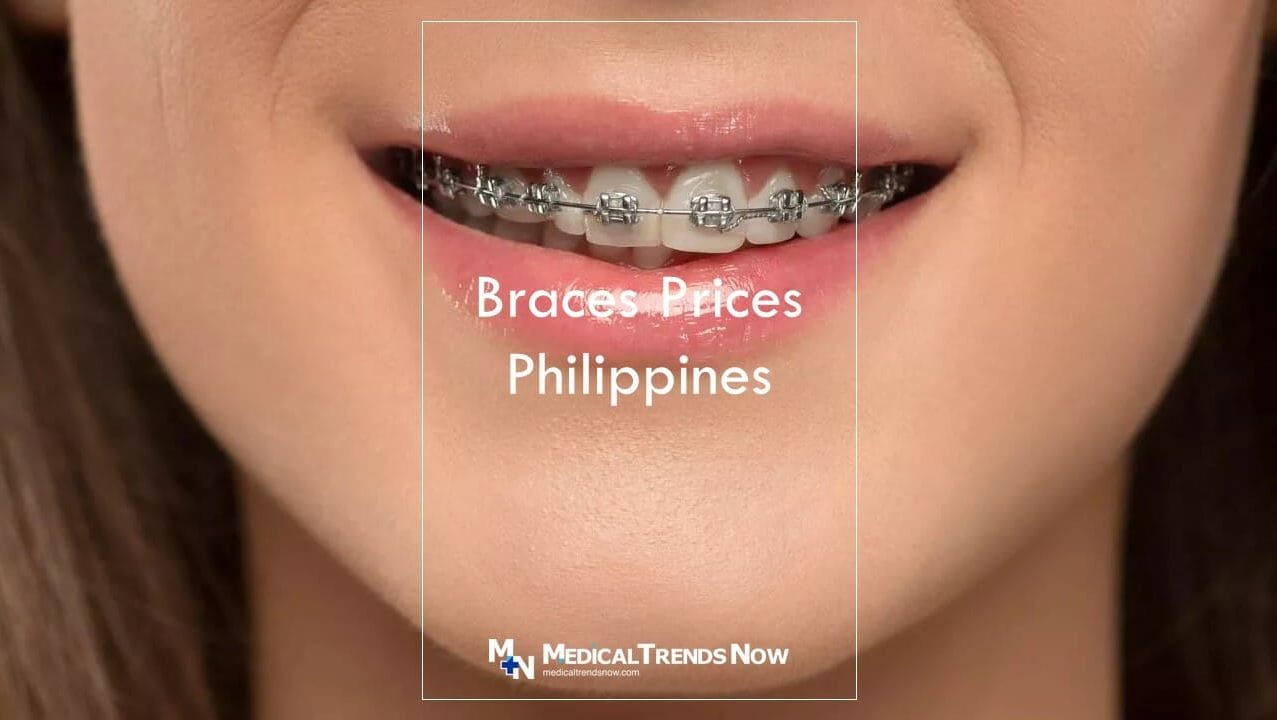 What are the best color for braces?