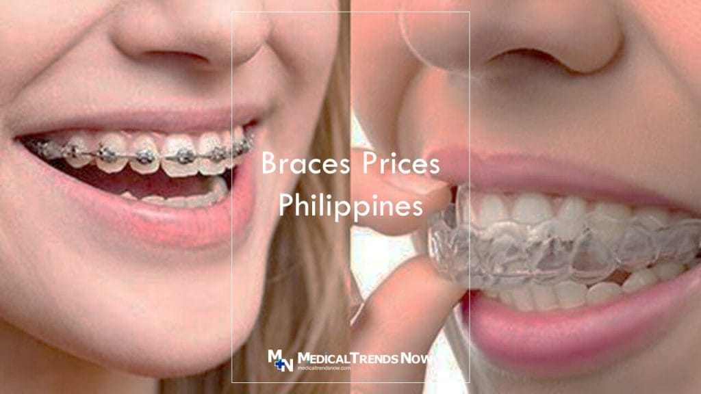 How much do braces cost for upper teeth only?