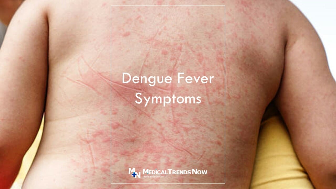 What Are the Signs & Symptoms of Dengue Fever? Dengue Fever (for Parents)