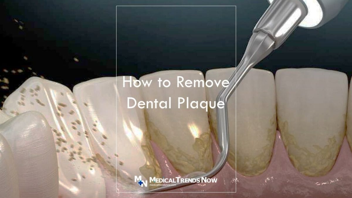 Which toothpaste is best for removing plaque?