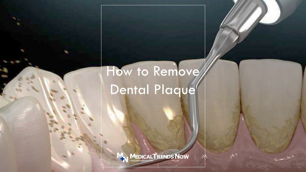 Which toothpaste is best for removing plaque?