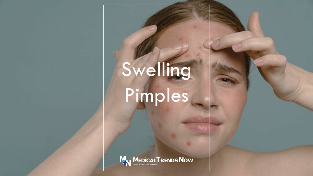 Don’t Let Swelling Pimples Ruin Your Day – Here’s How To Reduce Them ...