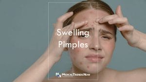 How to reduce the swelling of a pimple? How to treat deep, painful pimples