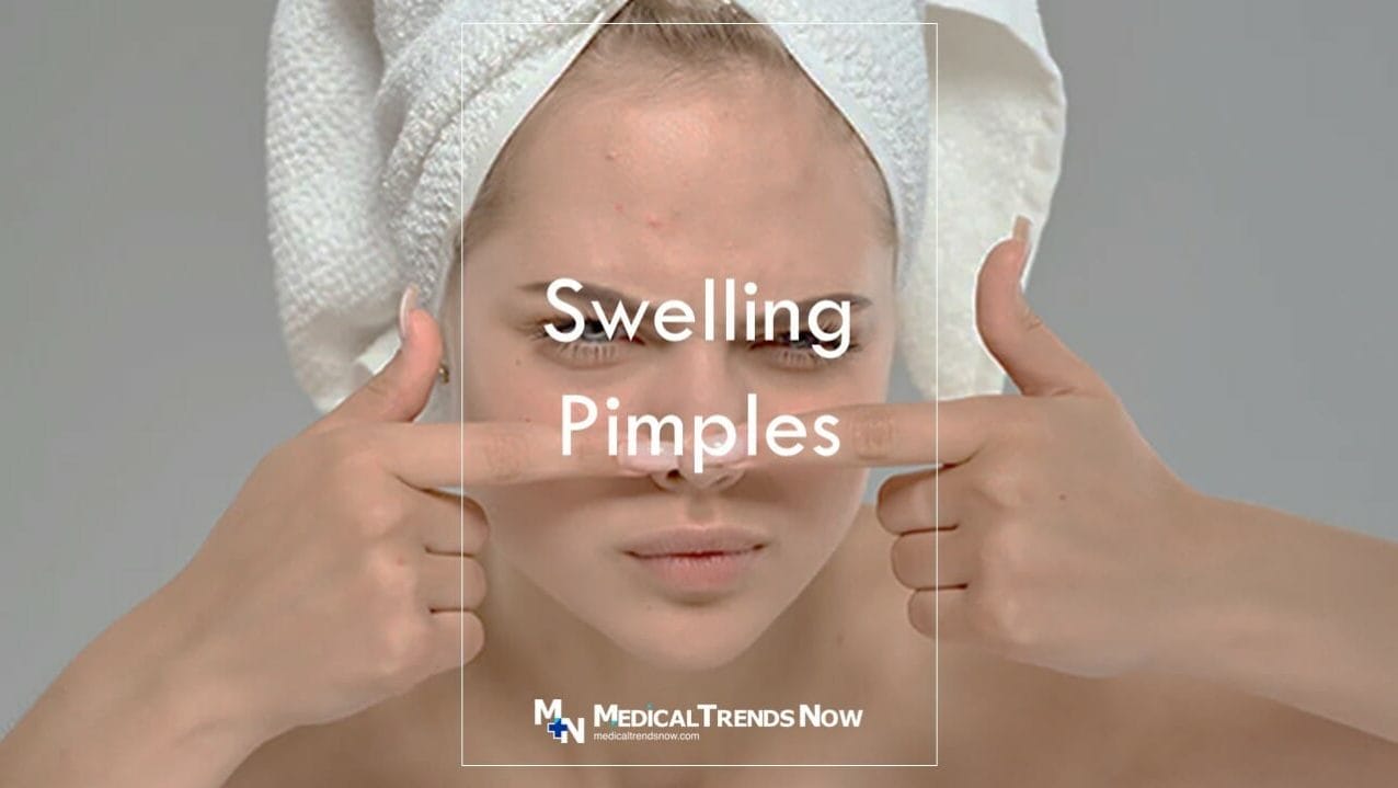 How long does a swollen pimple last? Steps to Heal a Big Pimple That Won't Go Away 