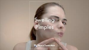 Is putting ice on pimples good? Ice on pimples: Does it help? 