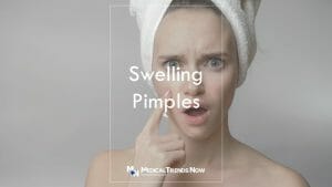 How do I get rid of a huge pimple overnight? How To Get Rid Of Pimples: 6 Overnight DIY Remedies To Try At Home