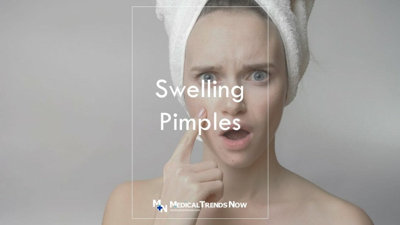 How do I get rid of a huge pimple overnight? How To Get Rid Of Pimples: 6 Overnight DIY Remedies To Try At Home