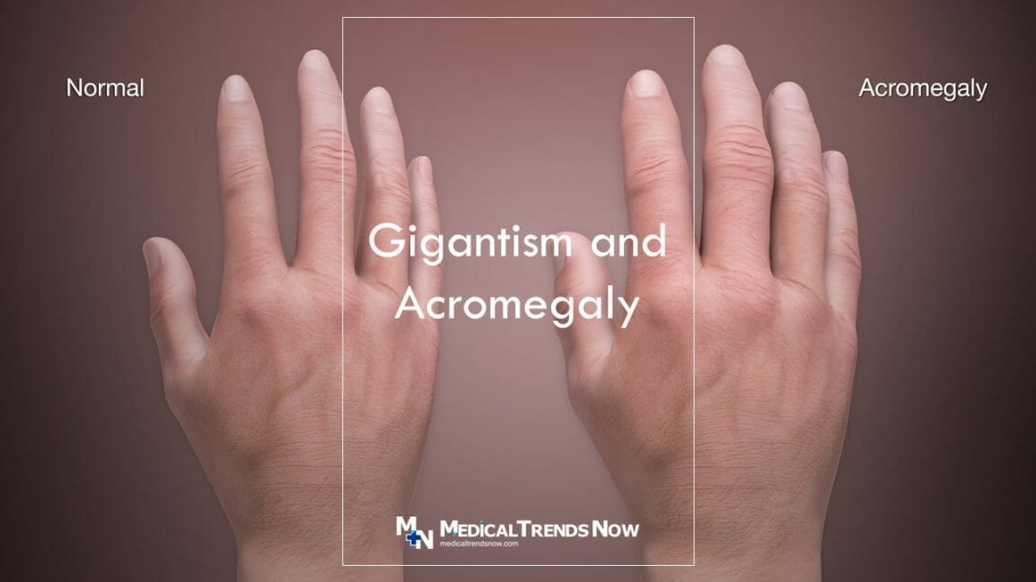 Warning Signs Of Gigantism And Acromegaly What To Do If You Notice Them Medical Trends Now