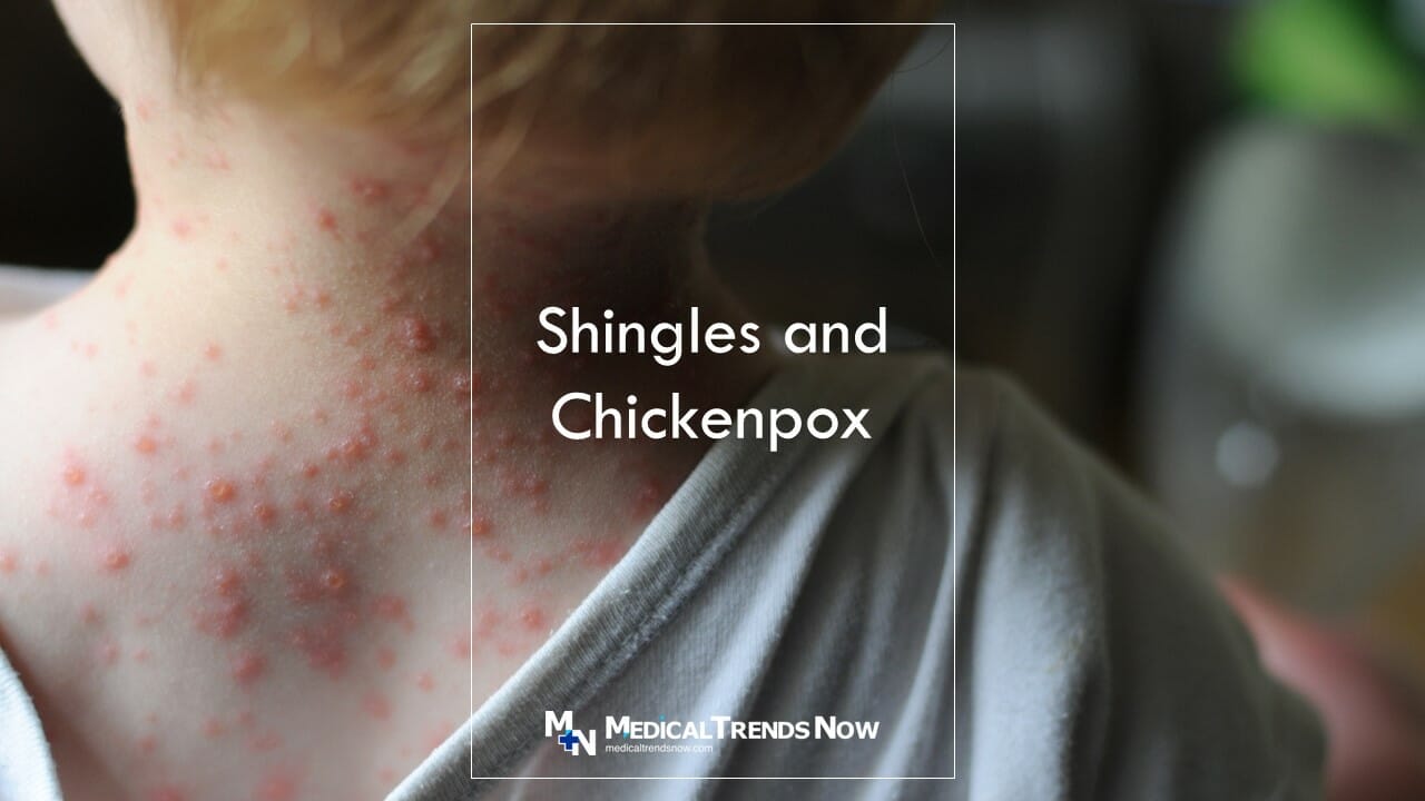 How do I know if I've ever had chicken pox? Chickenpox (Varicella) Signs and Symptoms