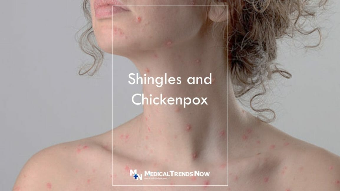 Can You Get Shingles If You Never Had Chickenpox? Here’s What You Need ...