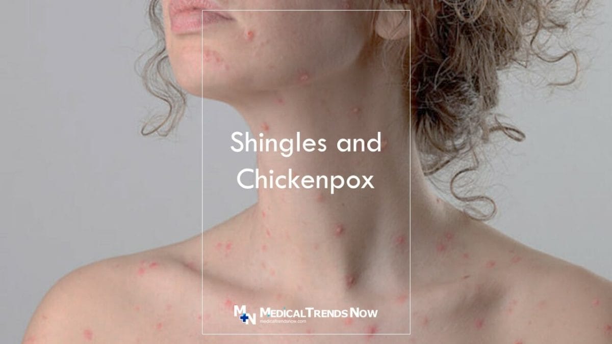 Can you get shingles even if vaccinated? Shingles Vaccine Facts & Side Effects 