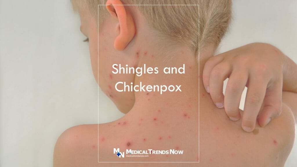 Can You Get Shingles If You Never Had Chickenpox? Here's What You Need ...