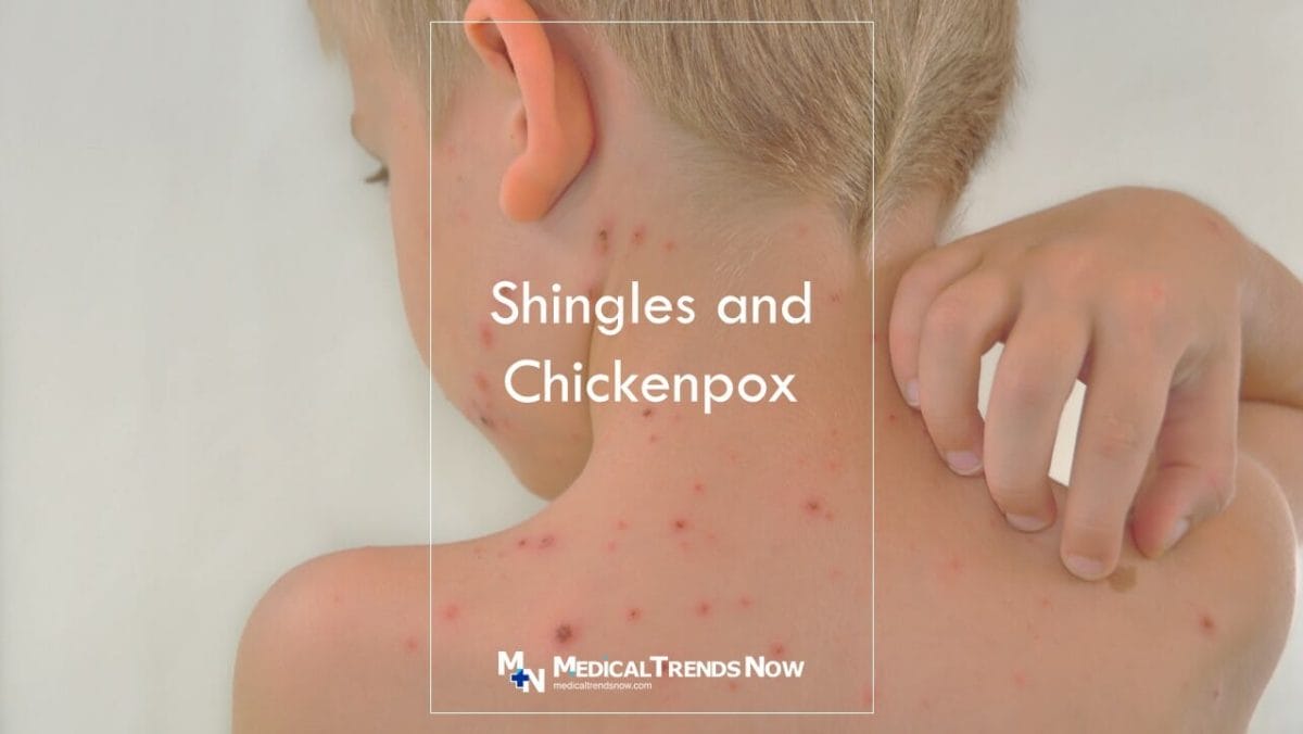 How do I know if my rash is shingles? Signs and Symptoms of Shingles (Herpes Zoster) 