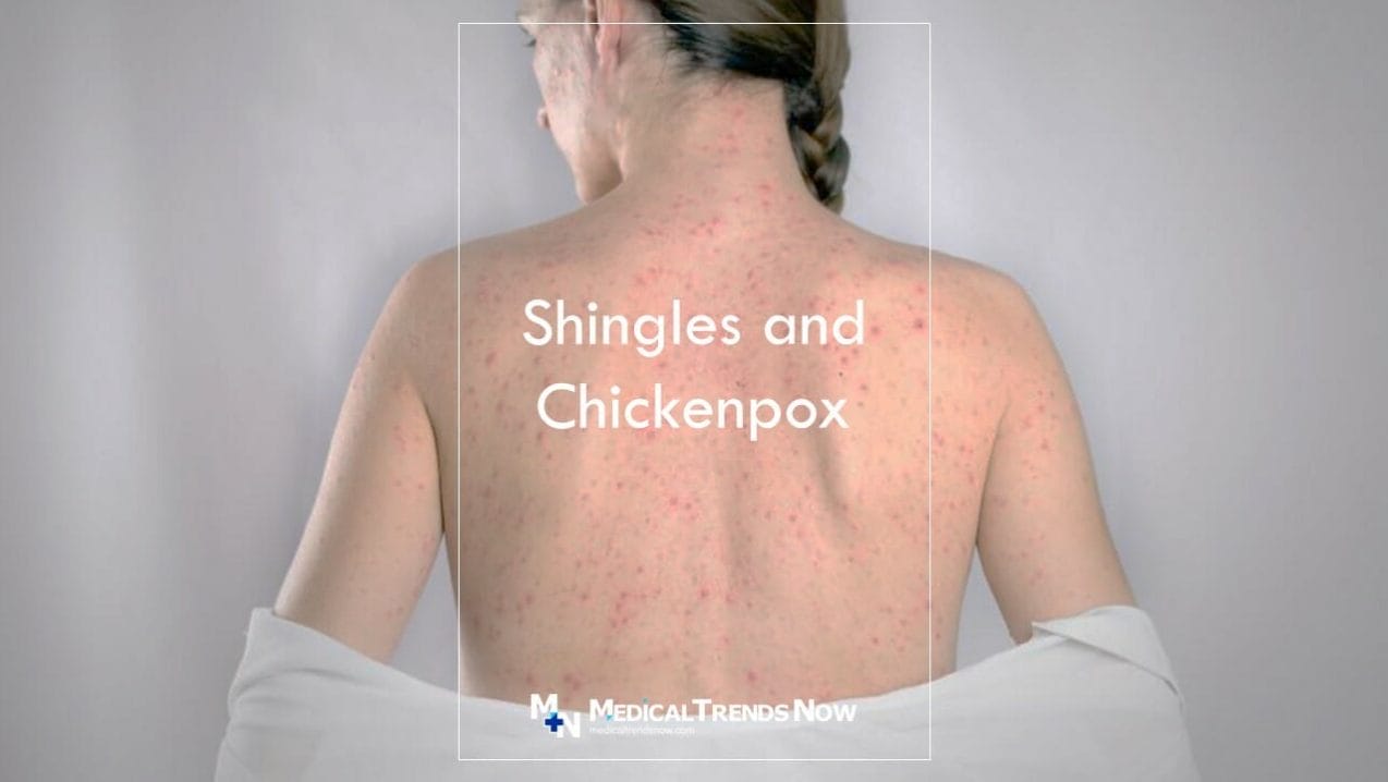 How did I get shingles if I never had chickenpox?