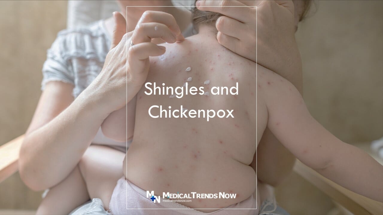 People cannot get shingles without having recovered from chickenpox