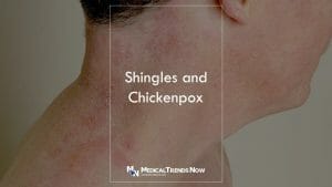 What happens if you've never had chickenpox? Do I Need The Shingles Vaccine If I've Never Had Chickenpox?