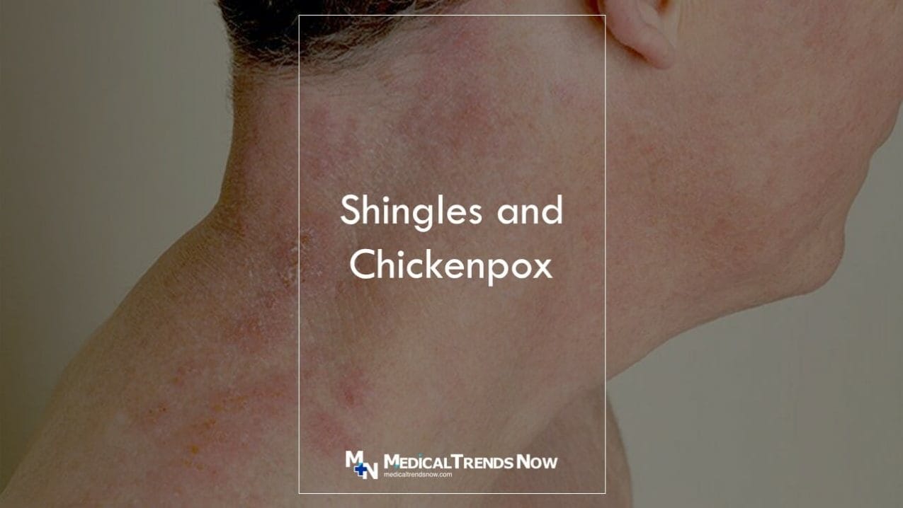 What happens if you've never had chickenpox? Do I Need The Shingles Vaccine If I've Never Had Chickenpox?