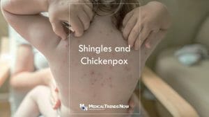 Do I need the shingles vaccine if I never had chickenpox? Shingles Zostavax Vaccination | What You Should Know | CDC