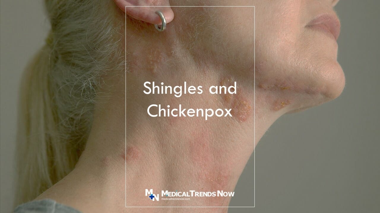 Can You Get Shingles If You Never Had Chickenpox? Here's What You Need ...