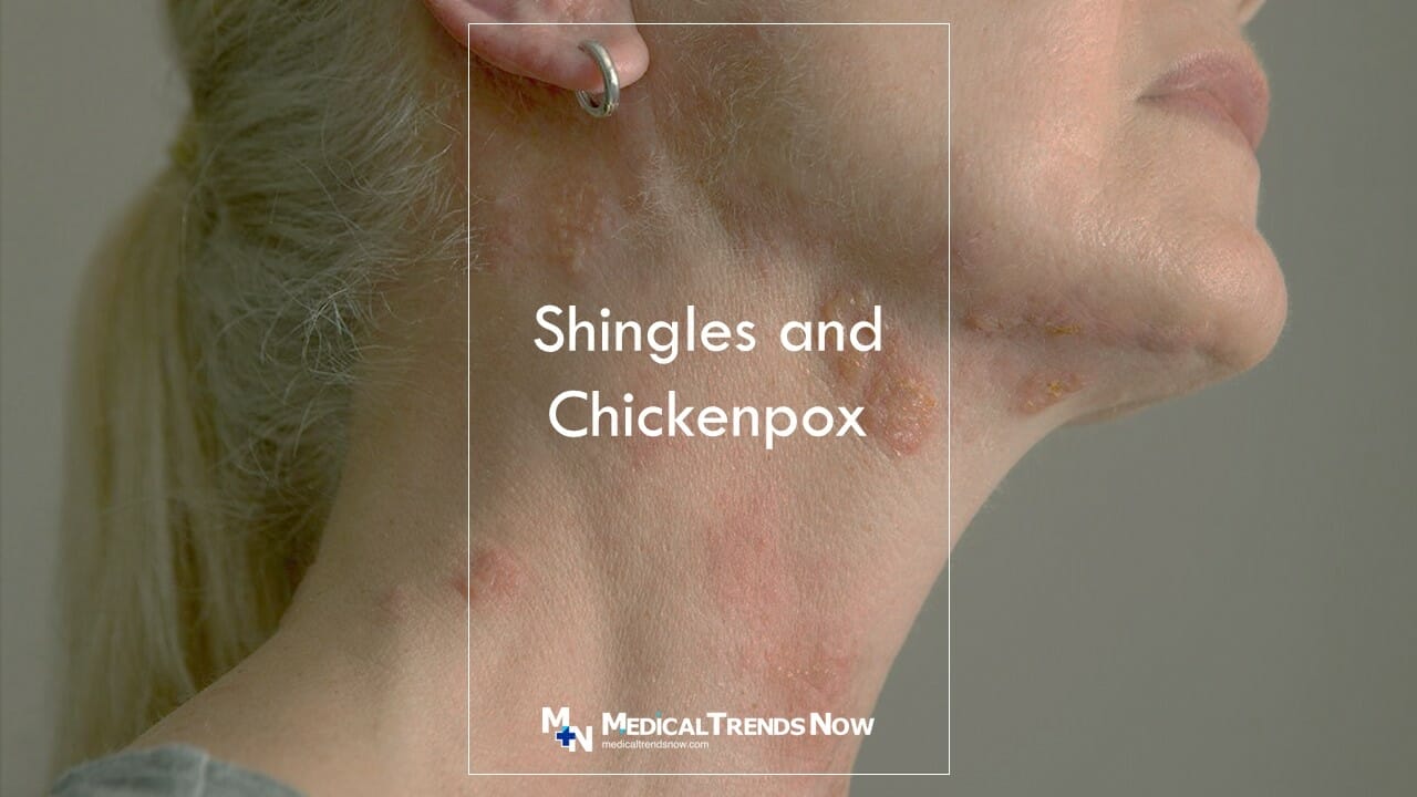 Can you get shingles if you are not immune to chickenpox? Will I Still Get Shingles If I've Had Chicken Pox? 