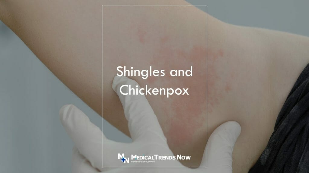 Can You Get Shingles If You Never Had Chickenpox? Here's What You Need ...