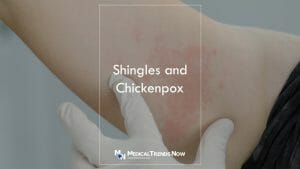 What triggers a shingles outbreak?