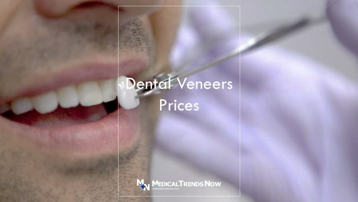 How much are veneers in the Philippines 2022? Veneers Price Philippines 2022 And Everything You Need To Know