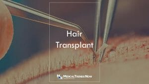 A hair transplant can give you permanent, natural-looking results