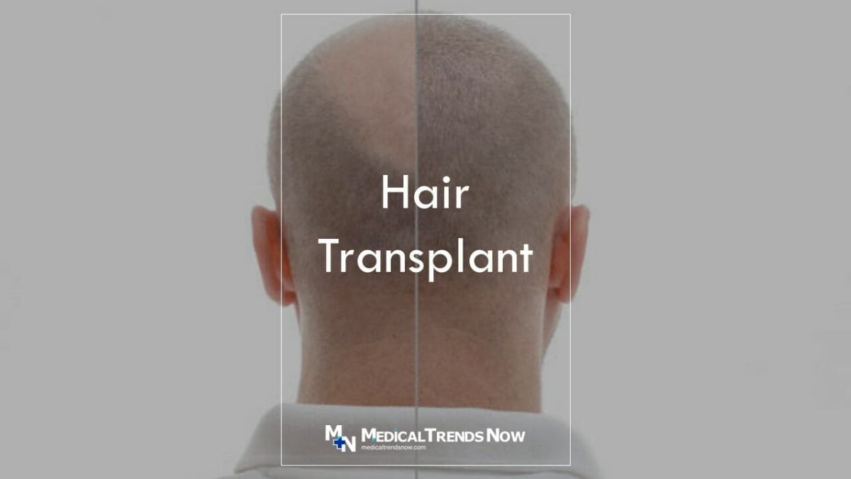Do hair transplants look natural?