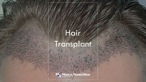 What is the best age to get a hair transplant?