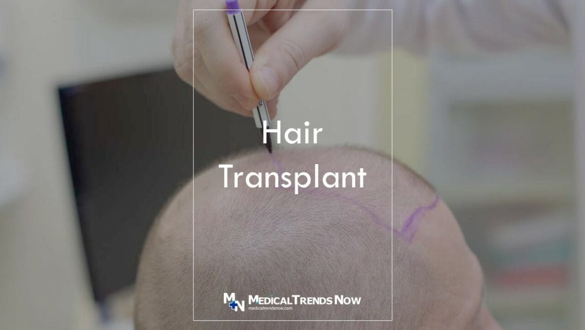Can you go bald after a hair transplant?