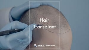 Hair Transplant: Procedure, Recovery, Complications, and More