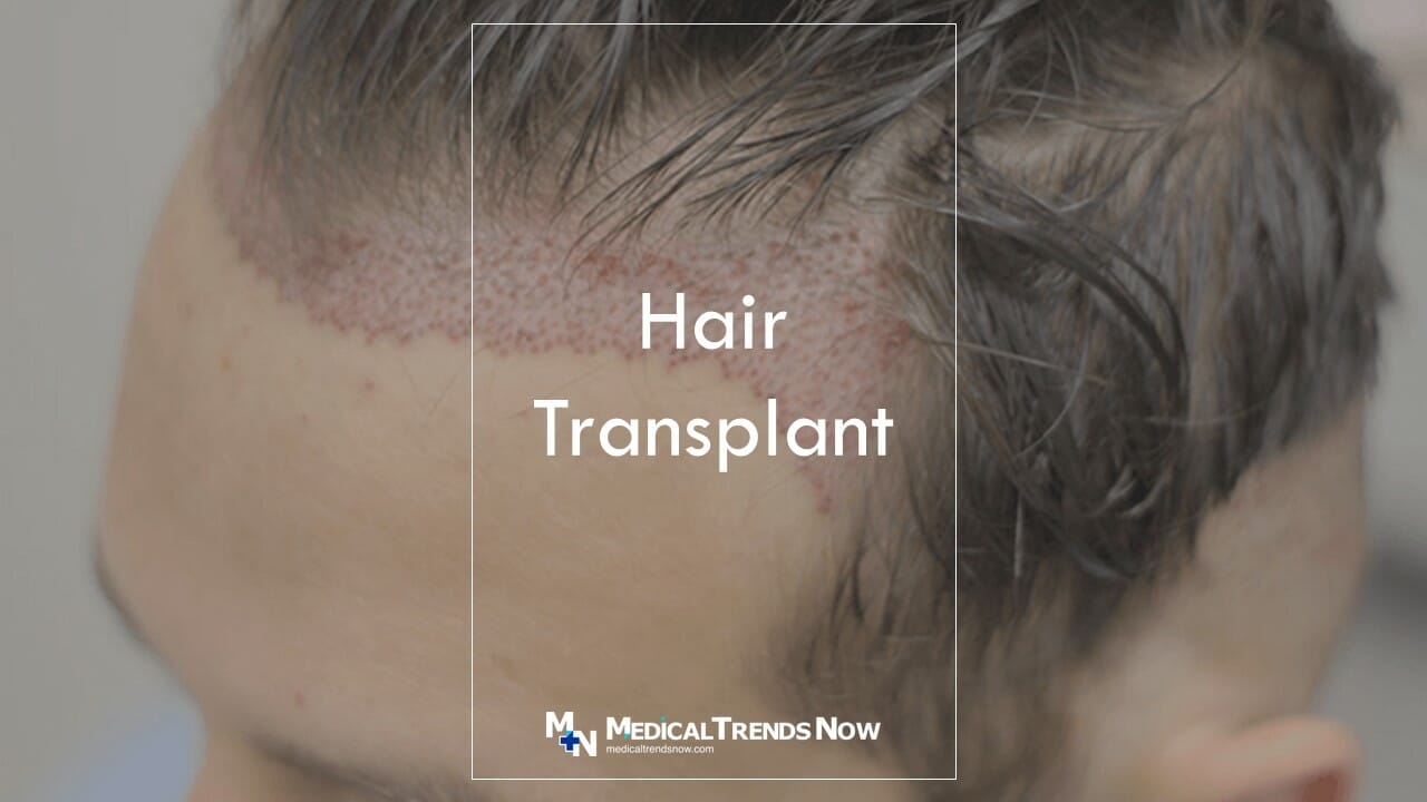 What are the disadvantages of hair transplant?