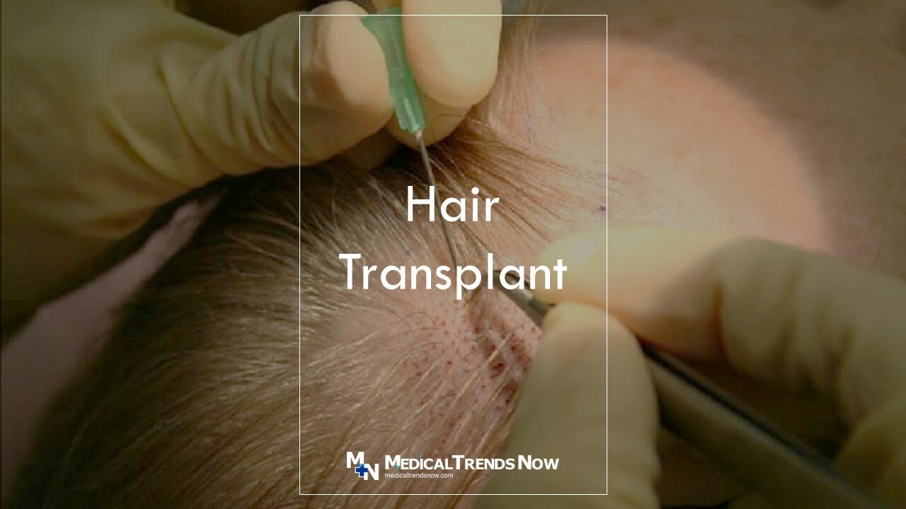 Is a Hair Transplant Permanent? What to Expect Long-Term 
