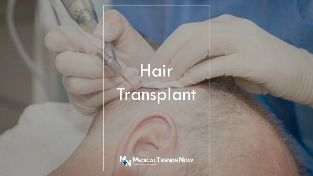 Is a hair transplant permanent?