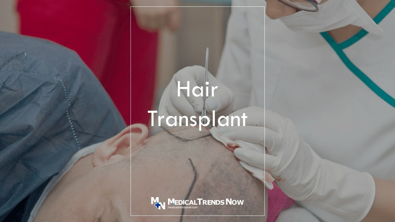 How long do hair transplants last?