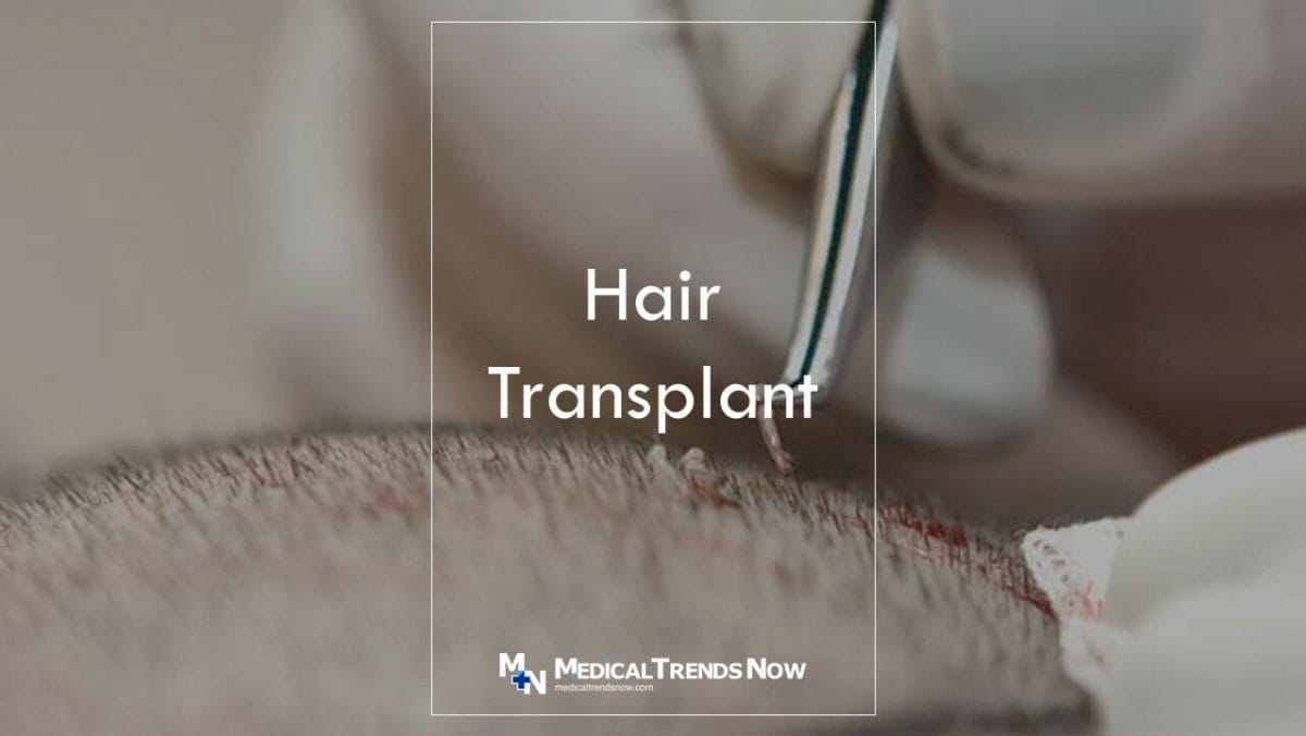 Hair Transplant in the Philippines: A New Hope For Balding Filipinos -  Medical Trends Now