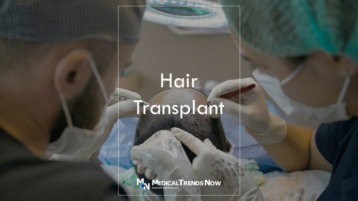 How many hair transplants can a person have? When Can I Get A Second Hair Transplant