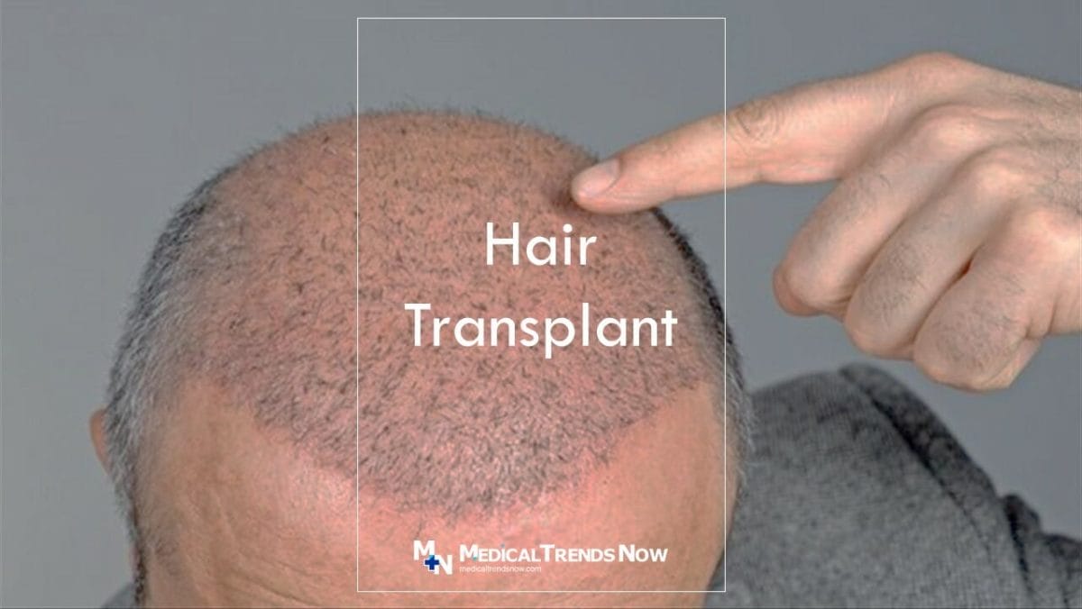 How much does hair transplant cost in Philippines?
