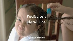 Why is Pediculosis infestation common in Filipino children?