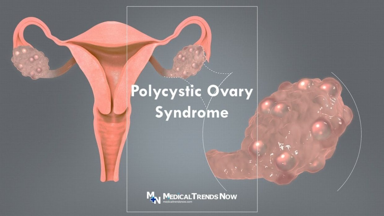 What pill is good for polycystic ovaries Philippines?