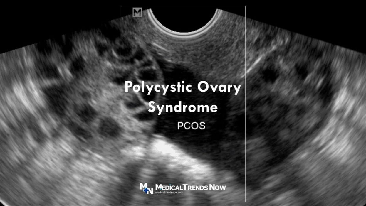 How many have PCOS in the Philippines?